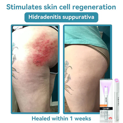 ✨QIAWI™ All-in-One CO₂ Laser Eraser Pen | Removes Moles, Warts, Skin Flaws & Pigmentation-1