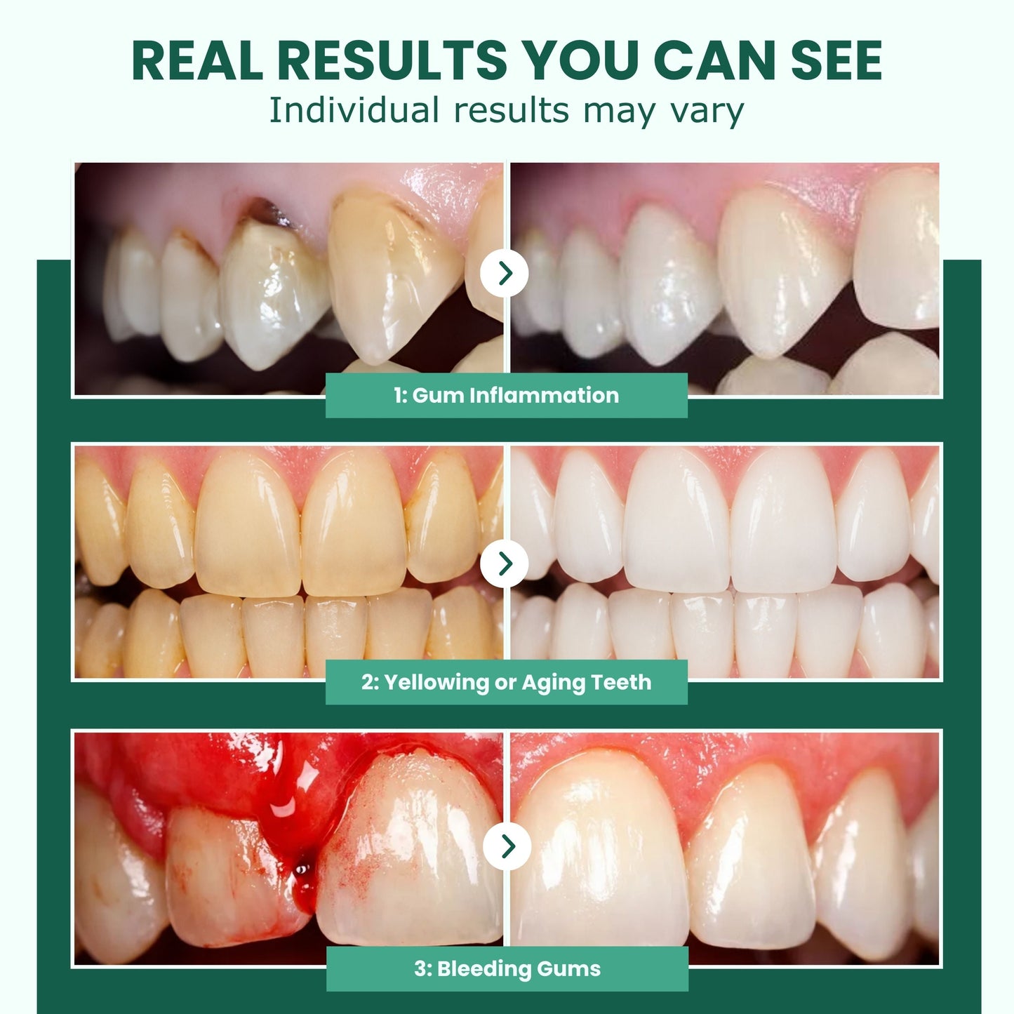 Freshooy - Teeth Repair Gel